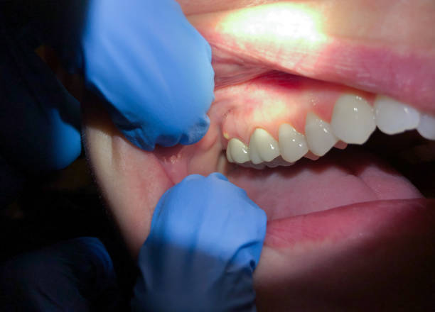 Best Dentist for Tooth Abscess  in St Augustine Shores, FL